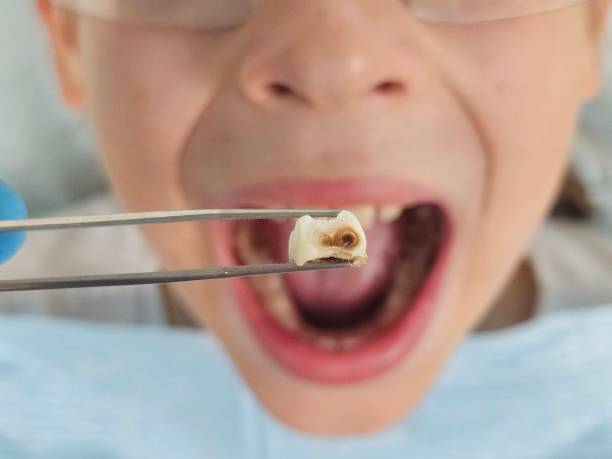 Best Emergency Dental Care for Abscessed Tooth in Winterset, IA